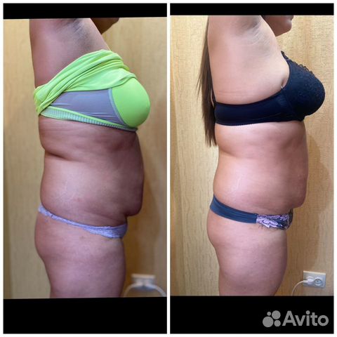Vela Shape Отзывы Фото До И После