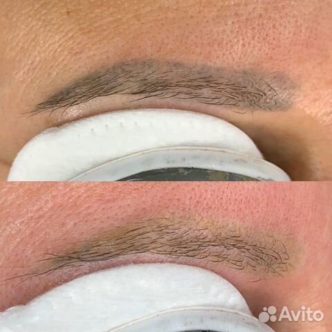 Удаление татуажа лазером